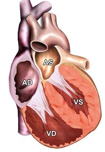 Cardiomiopatia dilatativa (cmd) (congestiva)